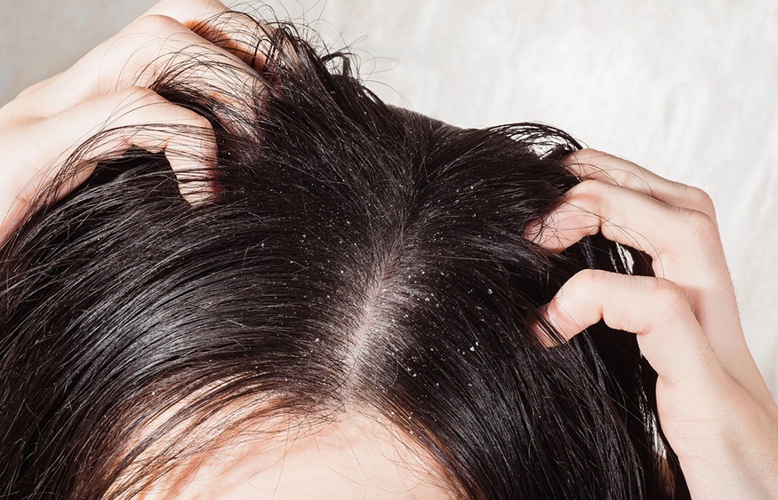 Discover which treatment for greasy scalps is meant for you.