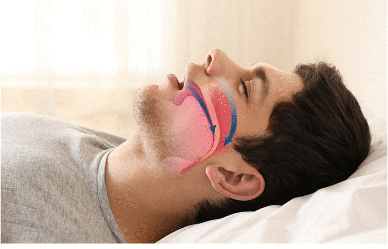How Snoring Surgery Can Improve Your Sleep and Daily Life