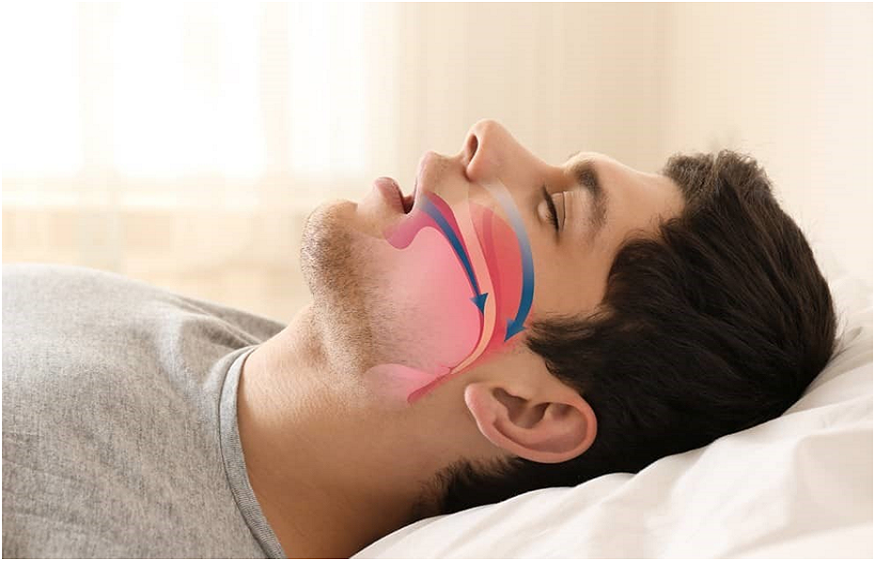 How Snoring Surgery Can Improve Your Sleep and Daily Life